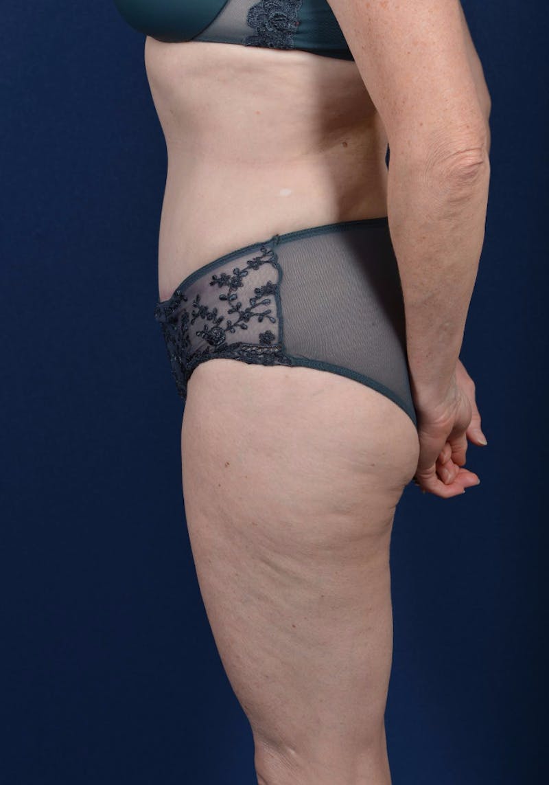 Abdominoplasty Before & After Gallery - Patient 9265557 - Image 6