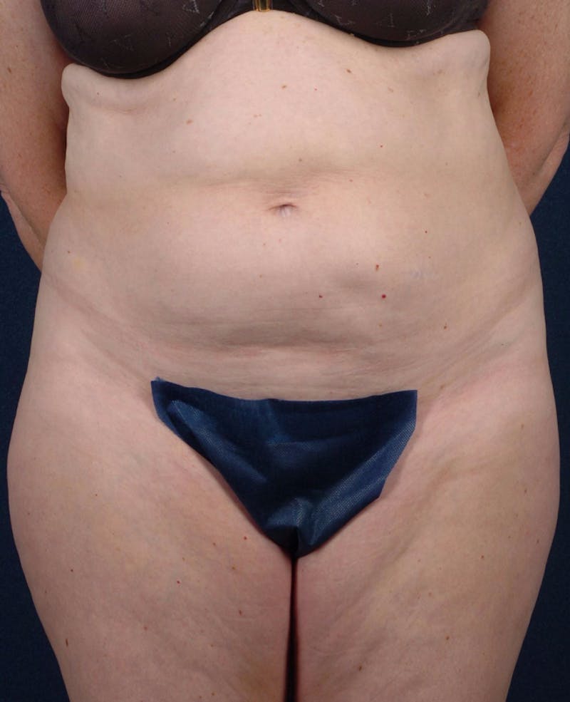 Abdominoplasty Before & After Gallery - Patient 9265563 - Image 1