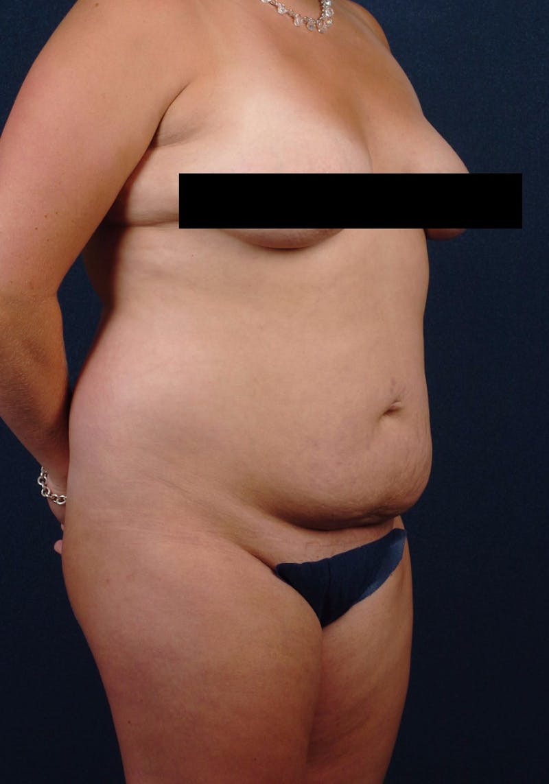 Abdominoplasty Before & After Gallery - Patient 9265561 - Image 5