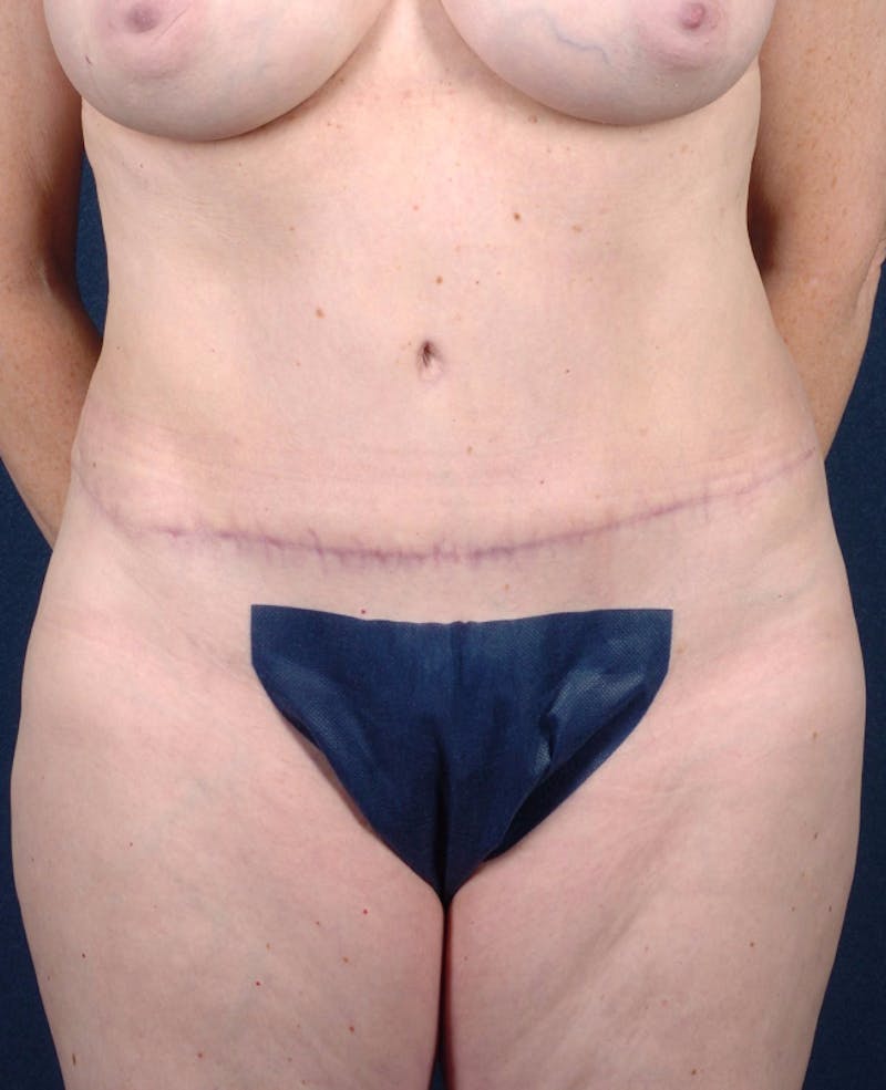 Abdominoplasty Before & After Gallery - Patient 9265563 - Image 2
