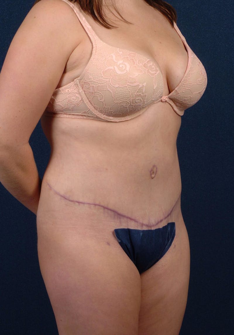 Abdominoplasty Before & After Gallery - Patient 9265561 - Image 6