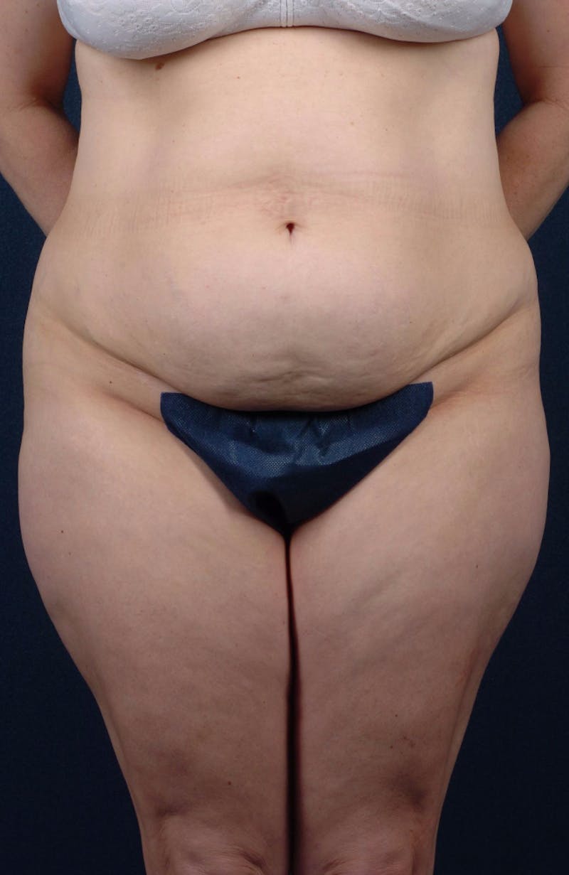 Abdominoplasty Before & After Gallery - Patient 9265565 - Image 1