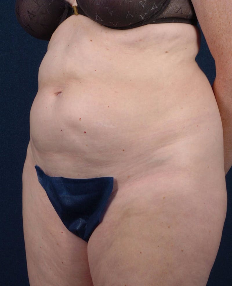 Abdominoplasty Before & After Gallery - Patient 9265563 - Image 3