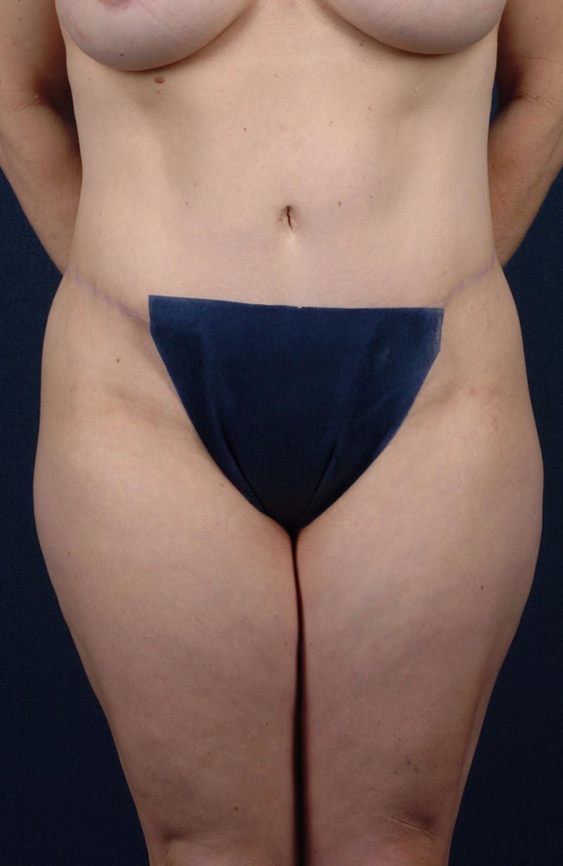 Abdominoplasty Before & After Gallery - Patient 9265565 - Image 2