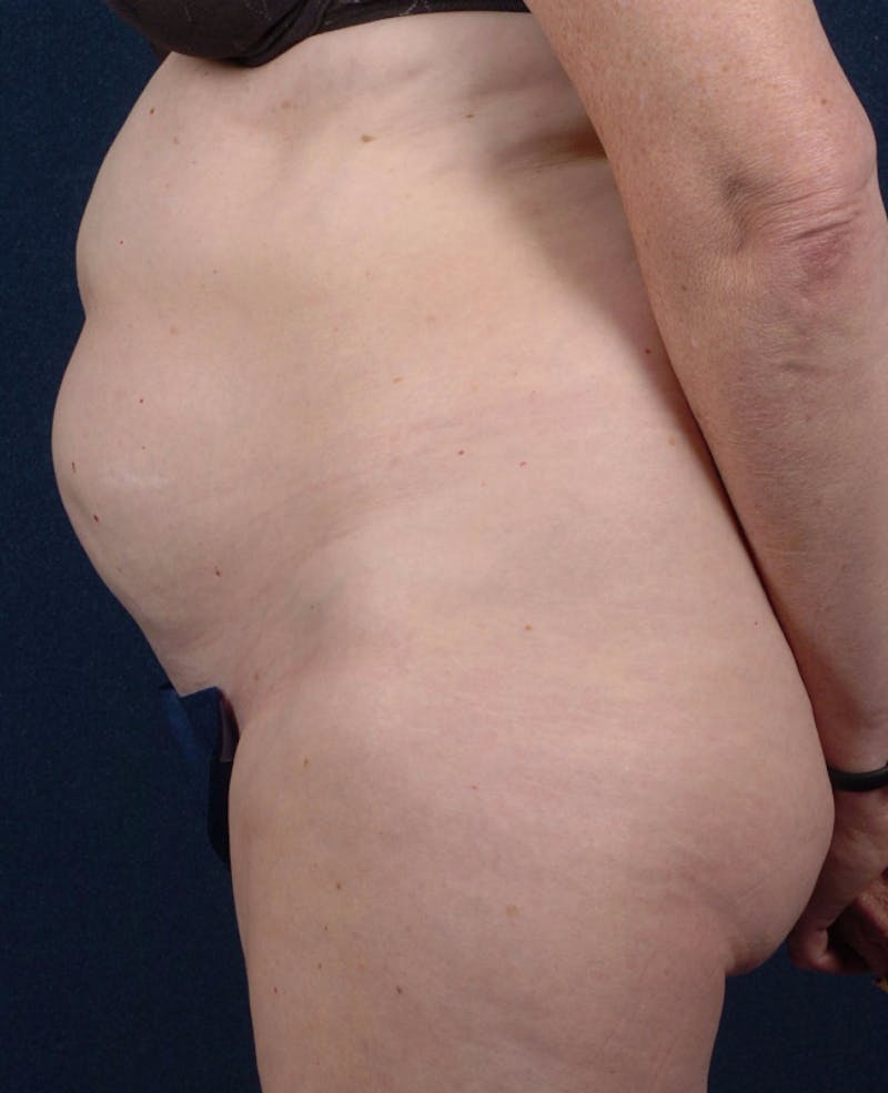 Abdominoplasty Before & After Gallery - Patient 9265563 - Image 5