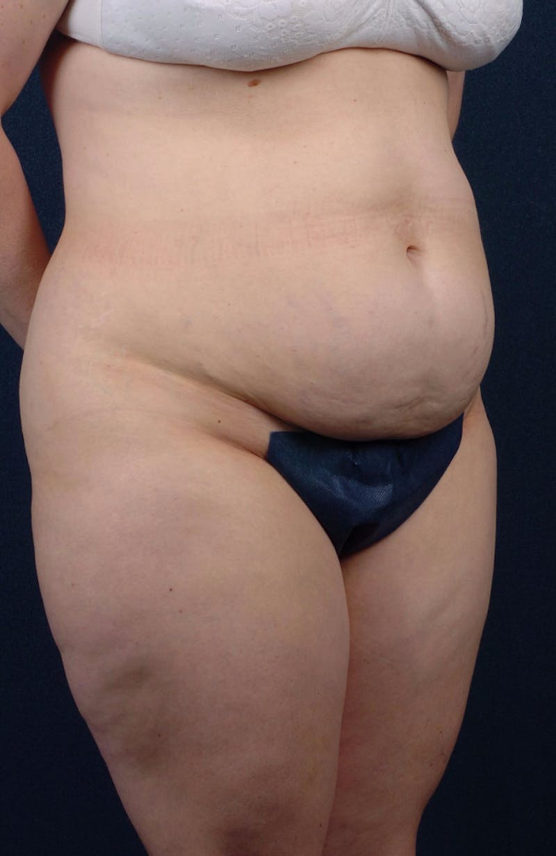 Abdominoplasty Before & After Gallery - Patient 9265565 - Image 3