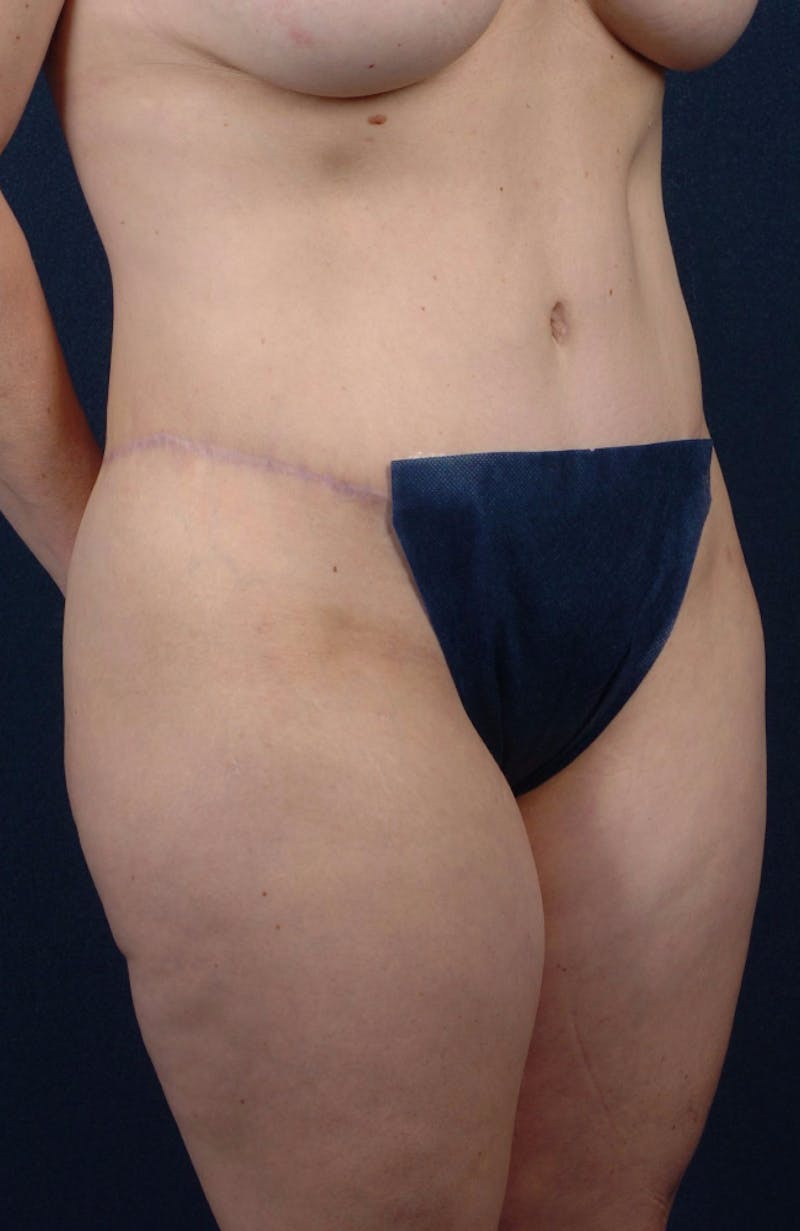Abdominoplasty Before & After Gallery - Patient 9265565 - Image 4