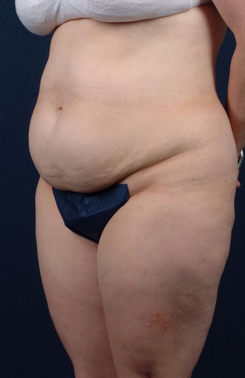Abdominoplasty Before & After Gallery - Patient 9265565 - Image 5