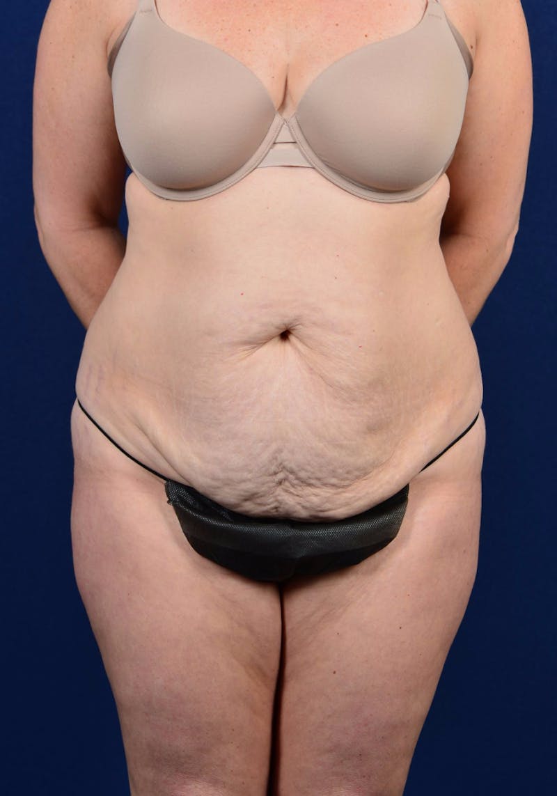 Abdominoplasty Before & After Gallery - Patient 9265574 - Image 1