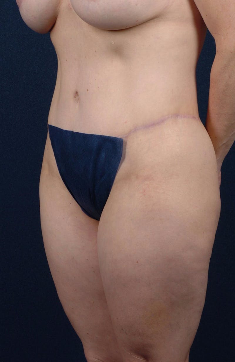 Abdominoplasty Before & After Gallery - Patient 9265565 - Image 6