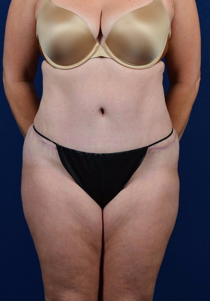 Abdominoplasty Before & After Gallery - Patient 9265574 - Image 2