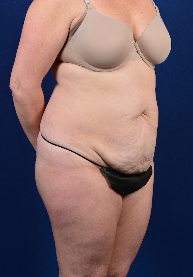 Abdominoplasty Before & After Gallery - Patient 9265574 - Image 3