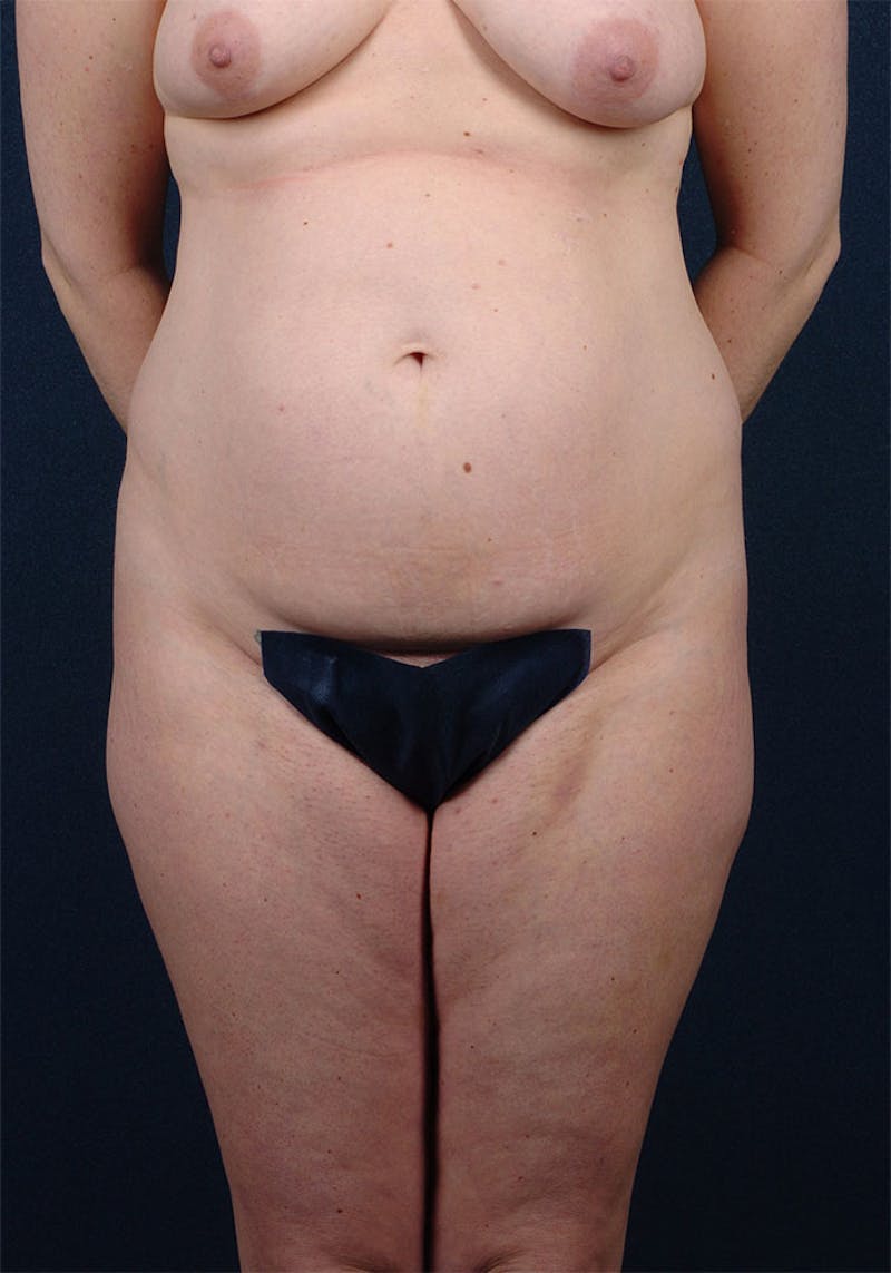 Abdominoplasty Before & After Gallery - Patient 9265577 - Image 1