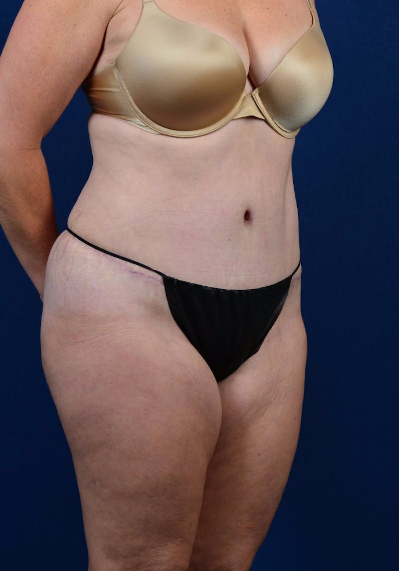 Abdominoplasty Before & After Gallery - Patient 9265574 - Image 4