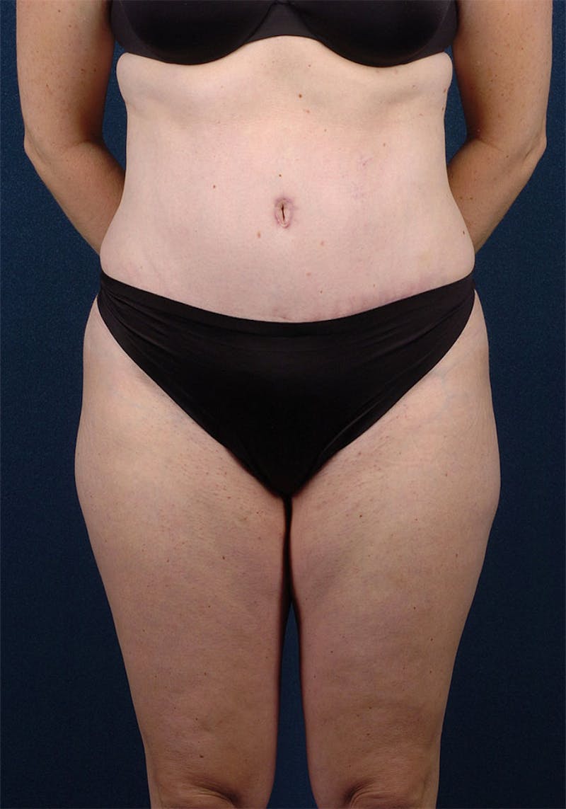 Abdominoplasty Before & After Gallery - Patient 9265577 - Image 2