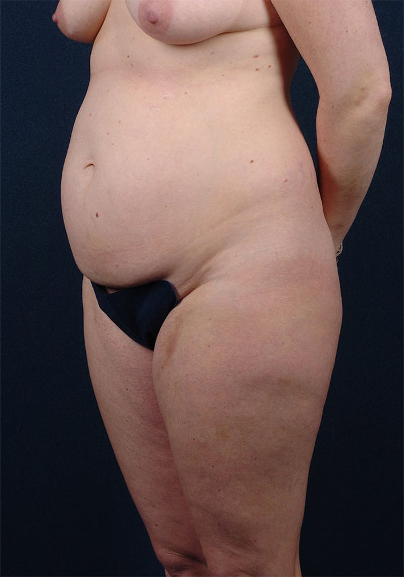 Abdominoplasty Before & After Gallery - Patient 9265577 - Image 3