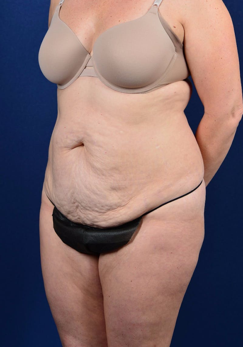 Abdominoplasty Before & After Gallery - Patient 9265574 - Image 5