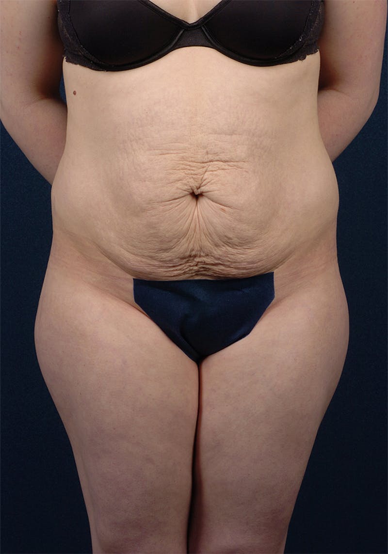 Abdominoplasty Before & After Gallery - Patient 9265578 - Image 1