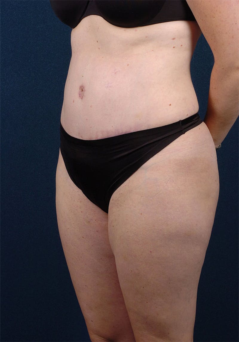 Abdominoplasty Before & After Gallery - Patient 9265577 - Image 4