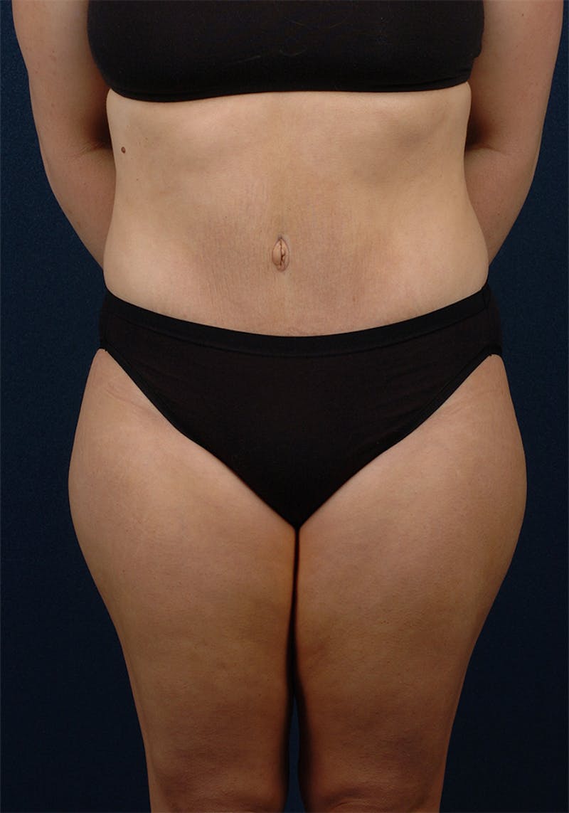 Abdominoplasty Before & After Gallery - Patient 9265578 - Image 2