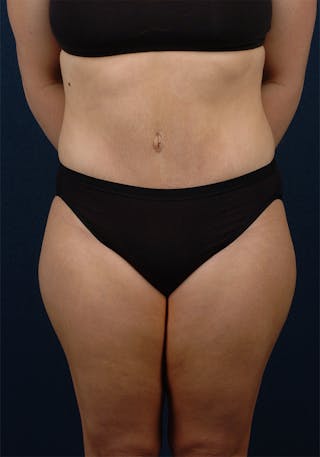 Abdominoplasty Before & After Gallery - Patient 9265578 - Image 2