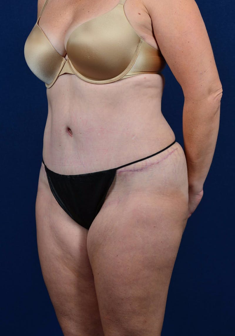 Abdominoplasty Before & After Gallery - Patient 9265574 - Image 6