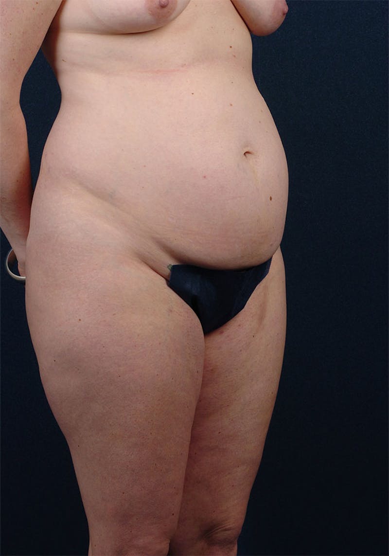 Abdominoplasty Before & After Gallery - Patient 9265577 - Image 5