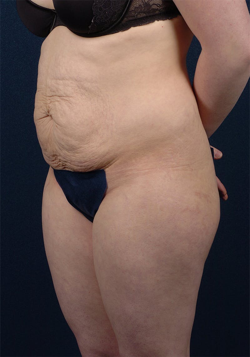 Abdominoplasty Before & After Gallery - Patient 9265578 - Image 3