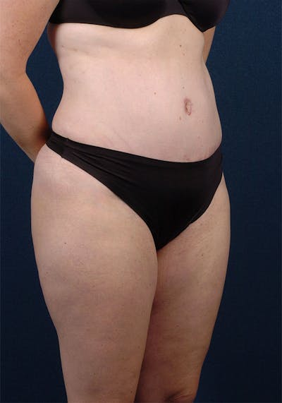 Abdominoplasty Before & After Gallery - Patient 9265577 - Image 6