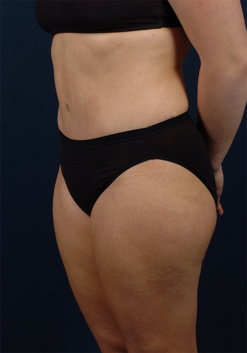Abdominoplasty Before & After Gallery - Patient 9265578 - Image 4