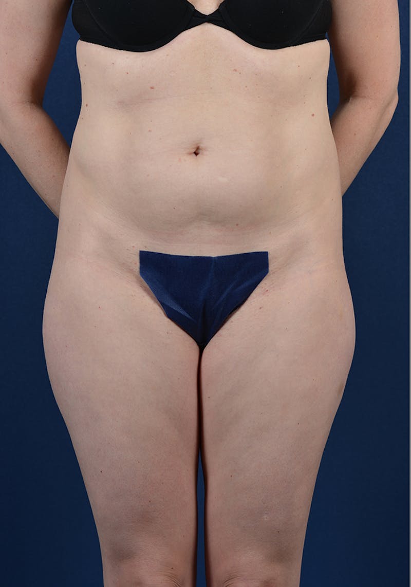 Abdominoplasty Before & After Gallery - Patient 9265583 - Image 1