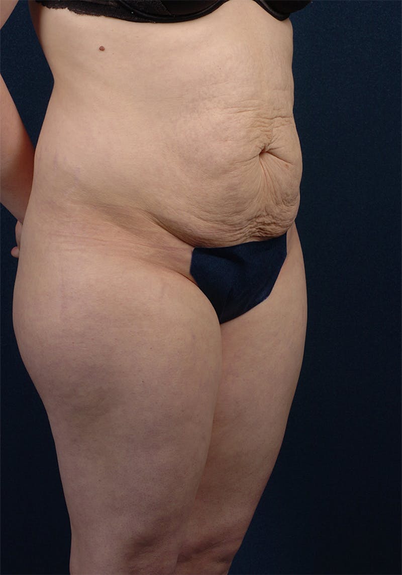 Abdominoplasty Before & After Gallery - Patient 9265578 - Image 5