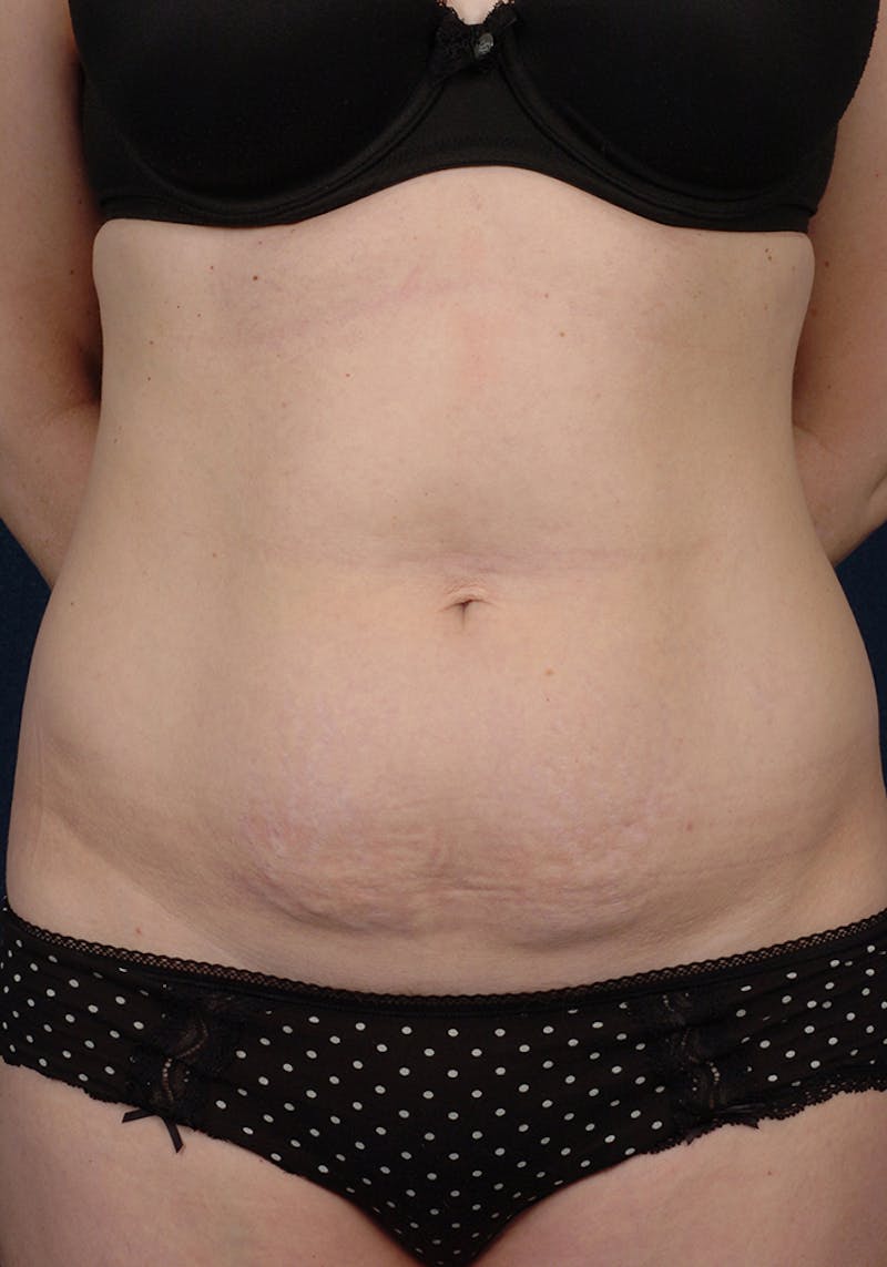 Abdominoplasty Before & After Gallery - Patient 9265585 - Image 1