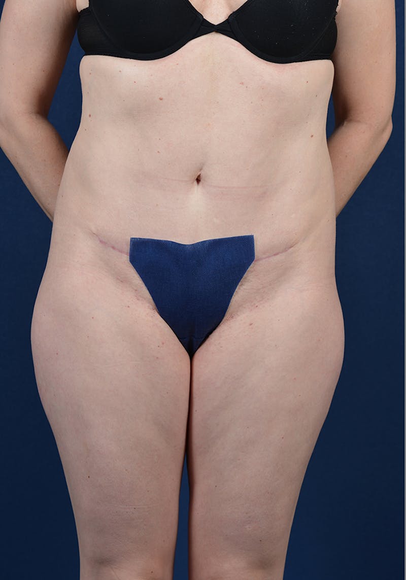 Abdominoplasty Before & After Gallery - Patient 9265583 - Image 2