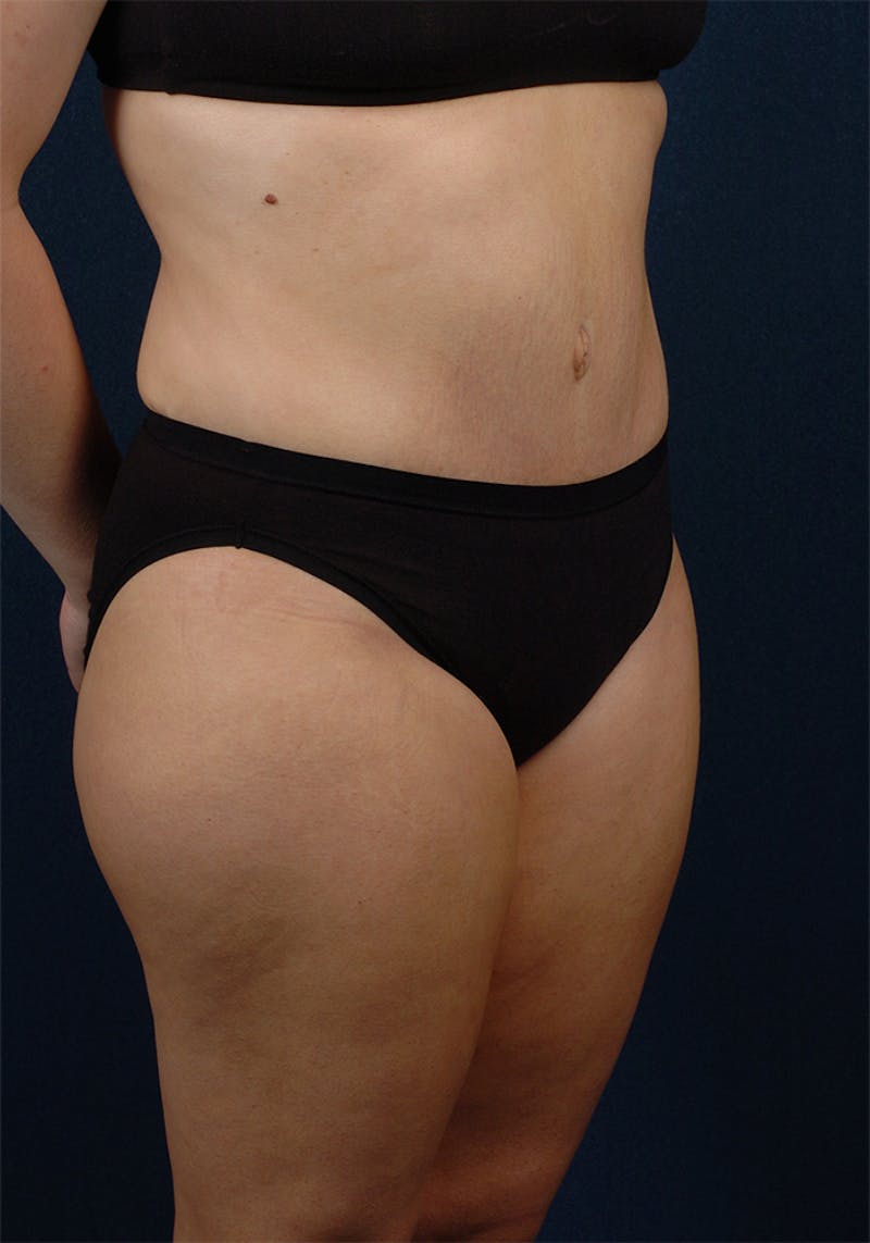 Abdominoplasty Before & After Gallery - Patient 9265578 - Image 6