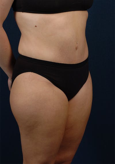 Abdominoplasty Before & After Gallery - Patient 9265578 - Image 6