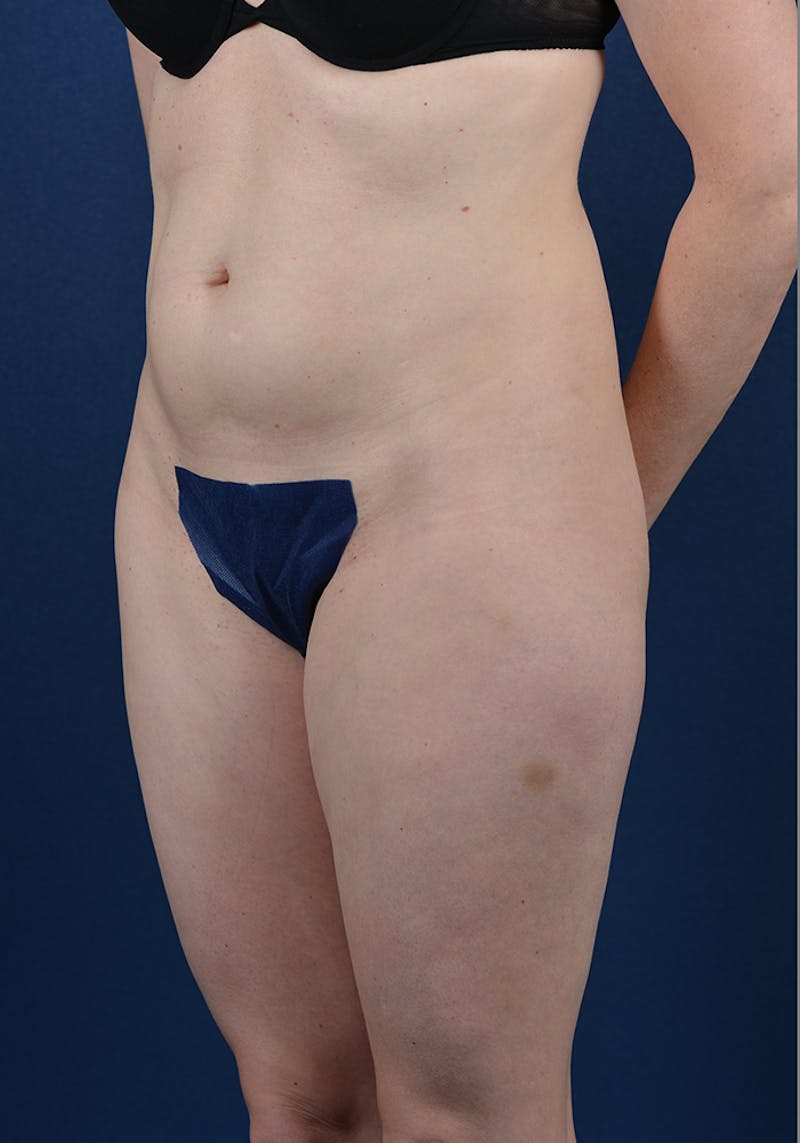 Abdominoplasty Before & After Gallery - Patient 9265583 - Image 3
