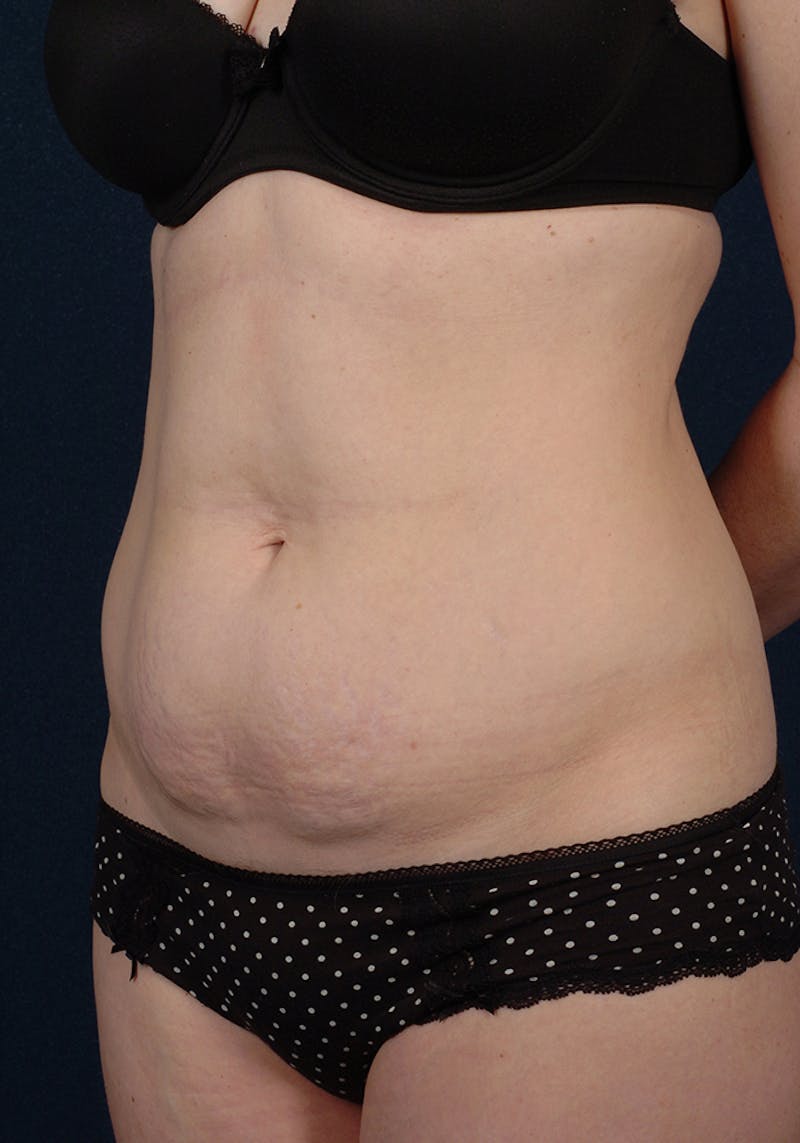 Abdominoplasty Before & After Gallery - Patient 9265585 - Image 3