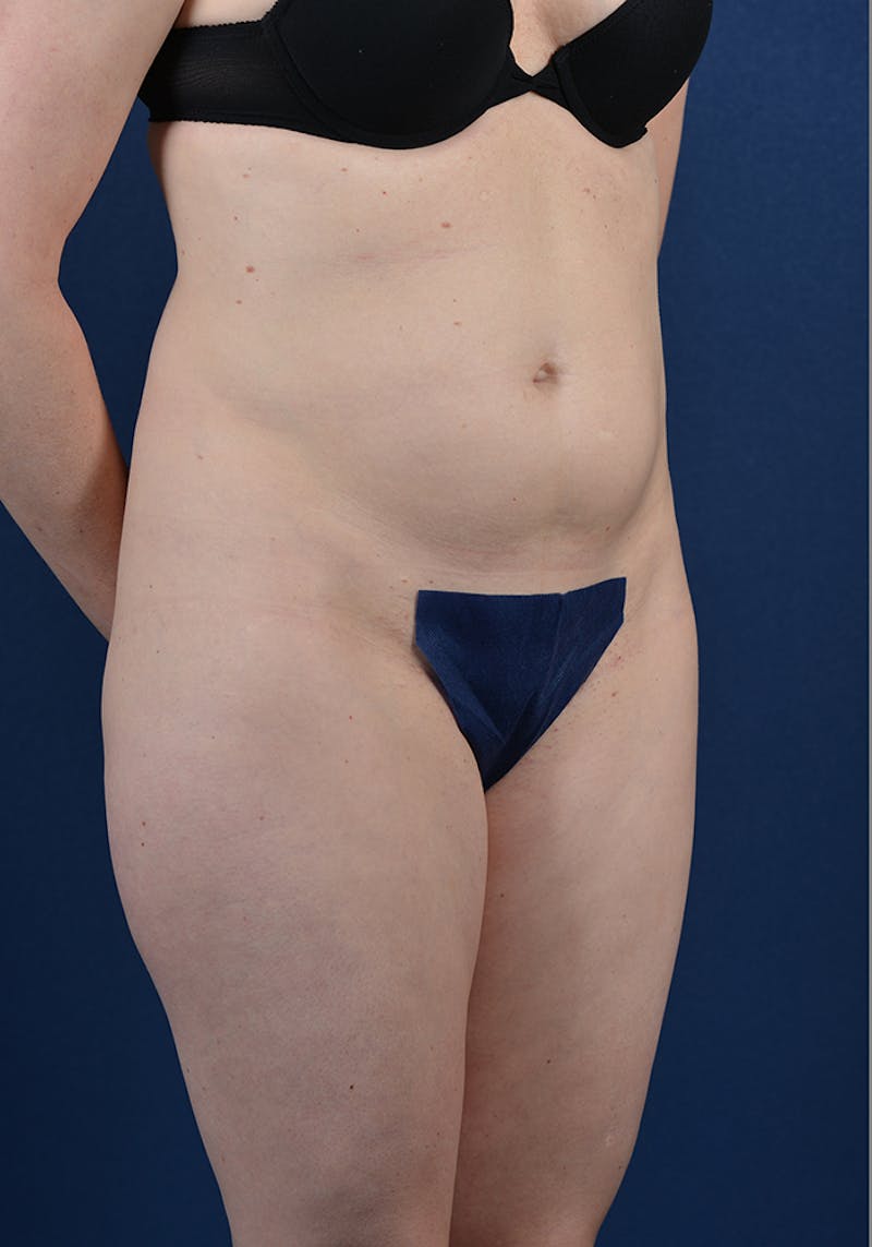 Abdominoplasty Before & After Gallery - Patient 9265583 - Image 5
