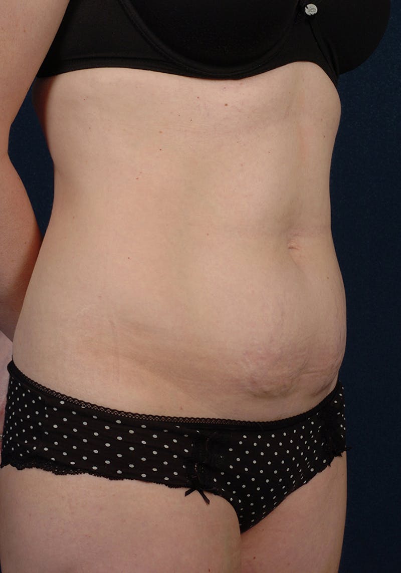 Abdominoplasty Before & After Gallery - Patient 9265585 - Image 5