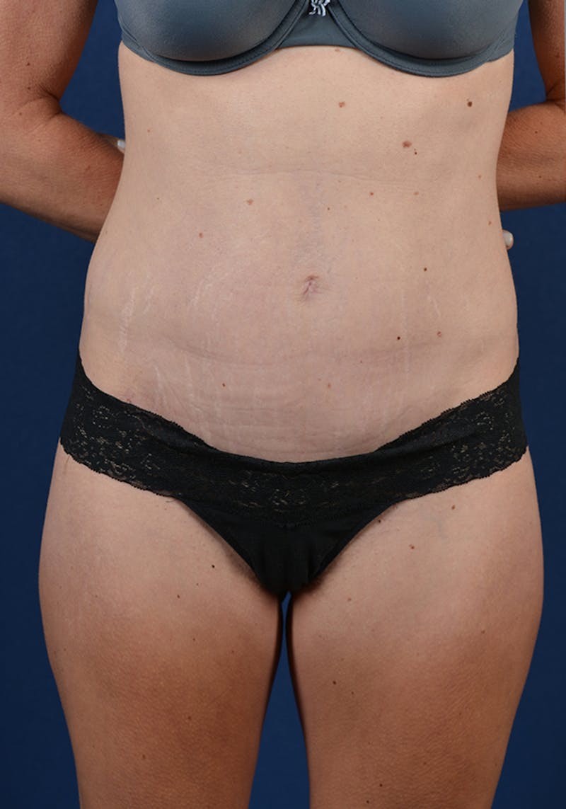 Abdominoplasty Before & After Gallery - Patient 9276097 - Image 2