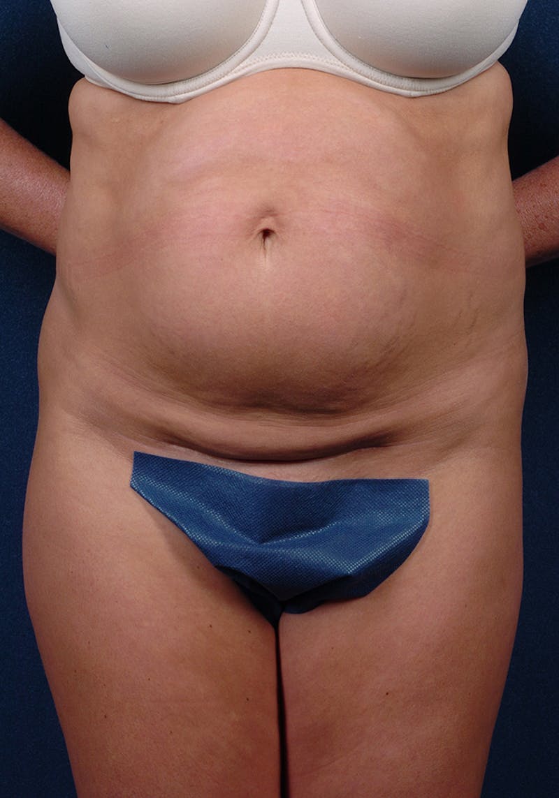 Abdominoplasty Before & After Gallery - Patient 9276101 - Image 1