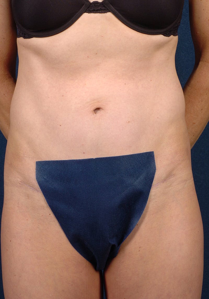 Abdominoplasty Before & After Gallery - Patient 9276098 - Image 2