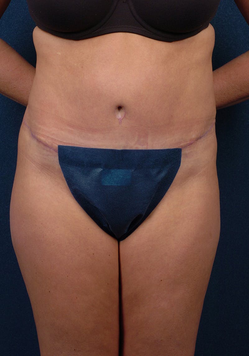 Abdominoplasty Before & After Gallery - Patient 9276101 - Image 2
