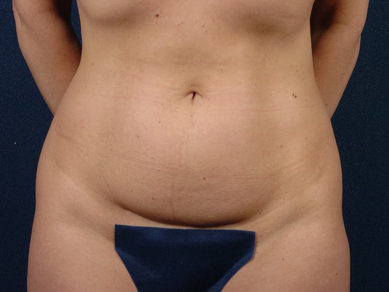 Abdominoplasty Before & After Gallery - Patient 9276104 - Image 1