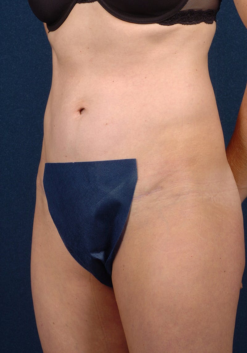 Abdominoplasty Before & After Gallery - Patient 9276098 - Image 4