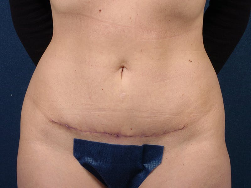 Abdominoplasty Before & After Gallery - Patient 9276104 - Image 2