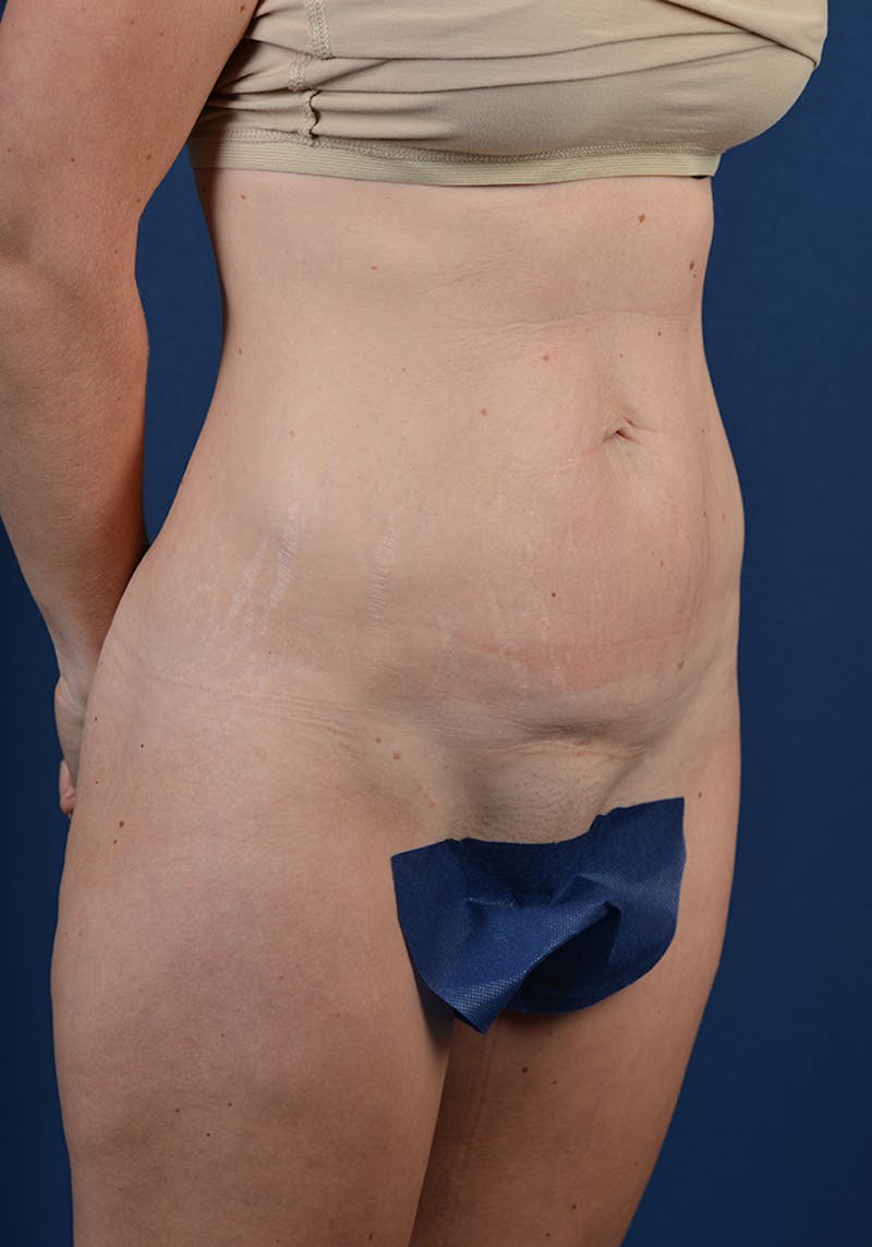 Abdominoplasty Before & After Gallery - Patient 9276097 - Image 5