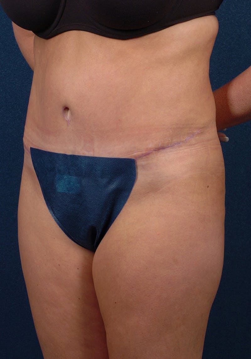 Abdominoplasty Before & After Gallery - Patient 9276101 - Image 4