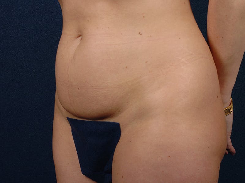 Abdominoplasty Before & After Gallery - Patient 9276104 - Image 3